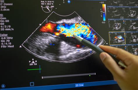 ultrasonic echo to ultrasound